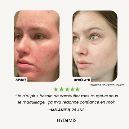 Pommeau Filtrant Peau sensible